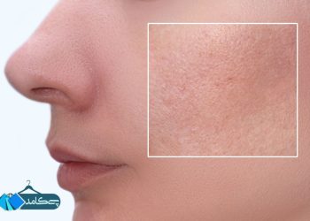 پوست چرب و منافذ باز